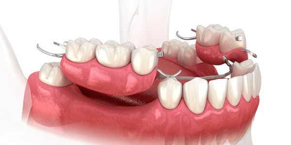 Dentures & Bridges