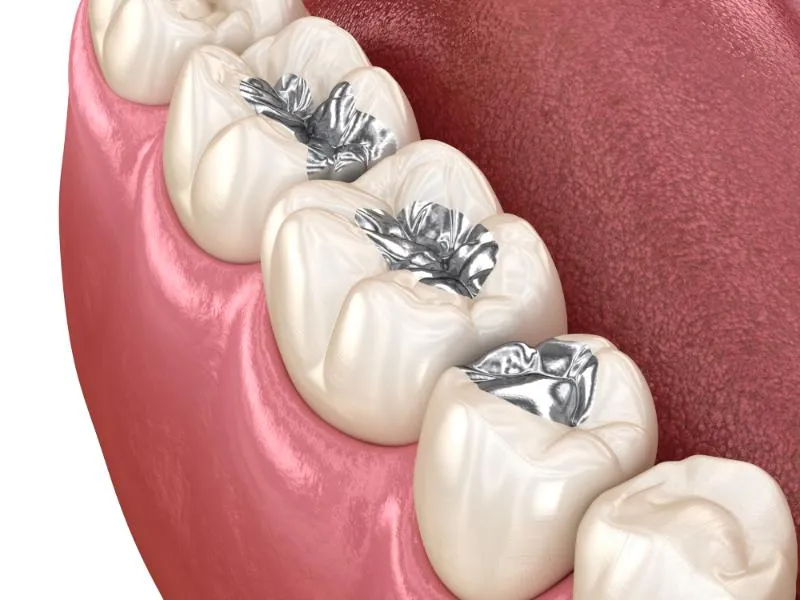 Fillings & Sealants