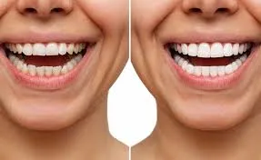 Teeth Reshaping