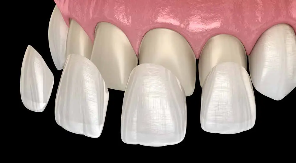 Veneers & Crowns